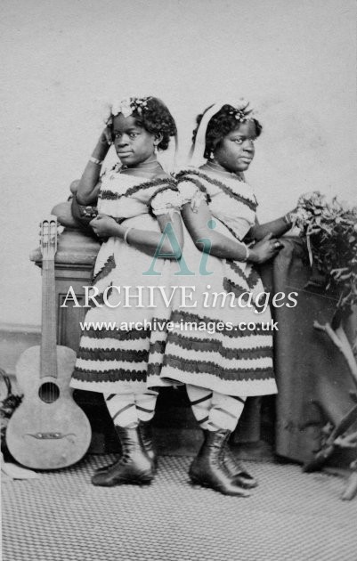 Siamese Twins Millie & Christine McCoy MD